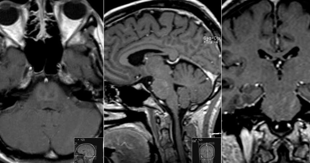 Radiology MRI: Central Pontine Myelinolysis